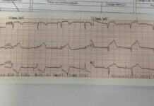 Dos infartos agudos de miocardio fueron tratados con éxito