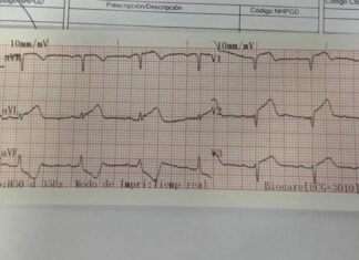Dos infartos agudos de miocardio fueron tratados con éxito